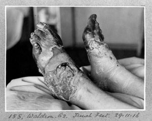 A case of trench foot which required plastic surgery, Wellcome Institute photo no. L0025834